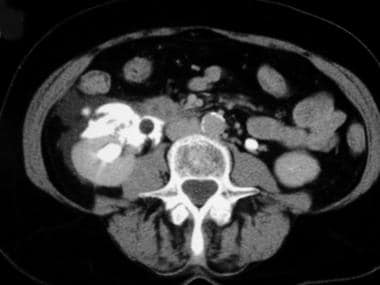 Axial contrast-enhanced CT scan. The excretory pha