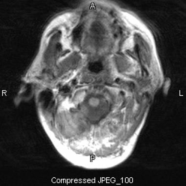 Parotid, malignant tumors. Axial T1-weighted MRI s
