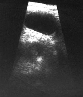 Further 3-month follow-up sonogram shows a conside