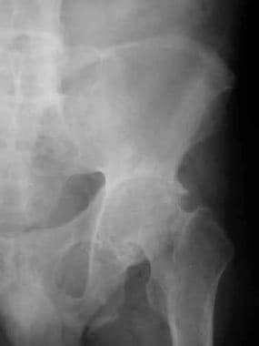Hip joint changes. Frontal radiograph shows unifor
