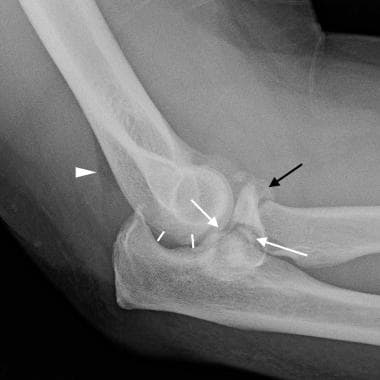 Elbow, fractures and dislocations. "Terrible triad