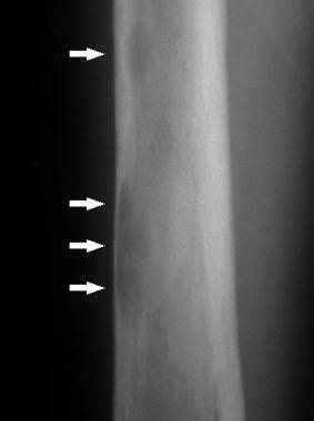 Radiograph of the femur in primary hyperparathyroi
