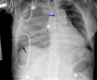 Supine anteroposterior (AP) thoraxradiografie toont