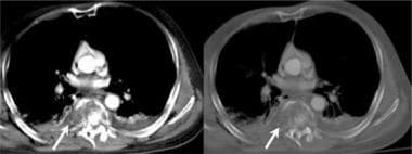 Thoracic spine trauma. Axial CT image demonstrates