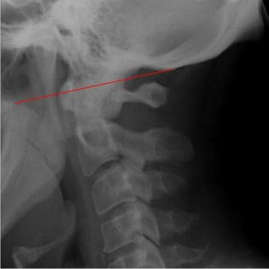Lateral radiograph of a normal cervical spine show