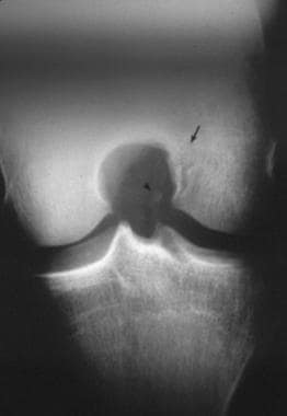 Anteroposterior radiograph of the right knee demon
