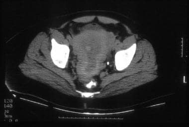 A 45-year-old woman with poorly differentiated end