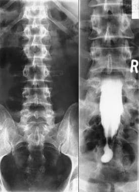 Left, plain anteroposterior (AP) radiograph of the