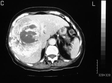 Contrast-enhanced, axial CT scan through the liver