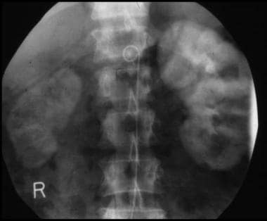 Fibromuscular dysplasia in a 36-year-old woman wit