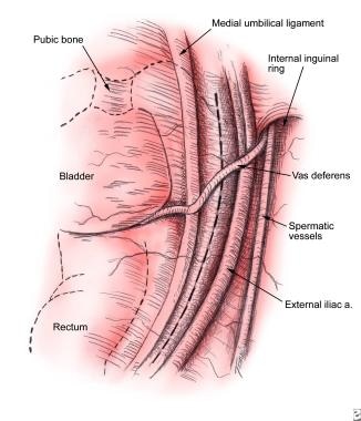 The medial umbilical ligament, iliac vessels, inte
