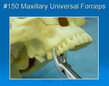 No. 150 maxillary universal forceps in place. 