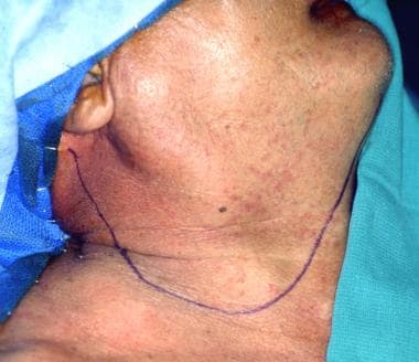 Apron incision used by the author for unilateral m