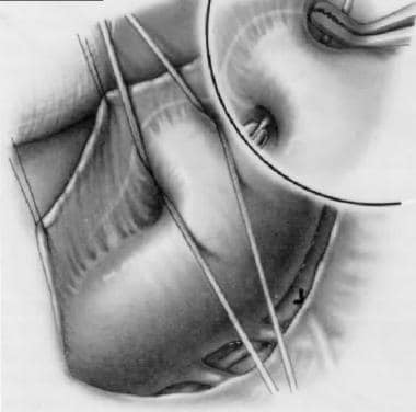 Patent Ductus Arteriosus Surgery. Patent ductus ar