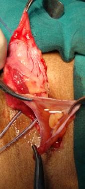 Open inguinal hernia repair. Contents of hernia sa