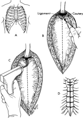 Illustration of a median sternotomy.