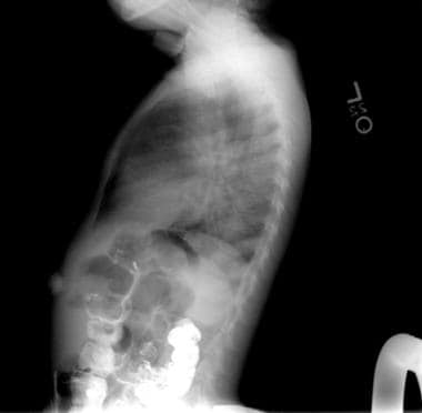 Lateral chest radiograph of the same child as in t