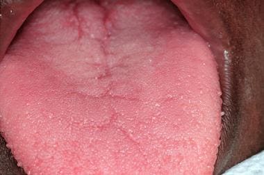 The dorsal surface of the tongue demonstrates gene
