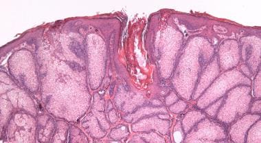 Histology of sebaceous hyperplasia; enlarged sebac
