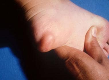 Plantar Fibromatosis Clinical Presentation: History ...