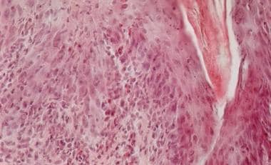 eosinophilic pustular folliculitis histology