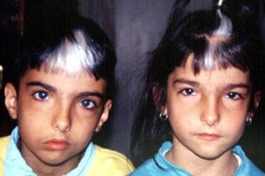 Brother and sister with Waardenburg syndrome. Imag