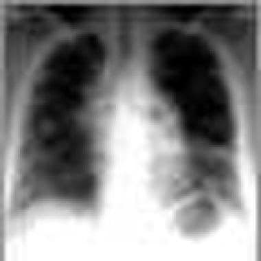 Advanced chest radiograph findings in sarcoidosis.