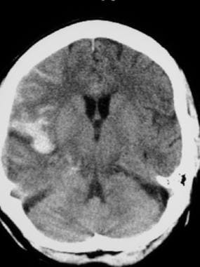 CT scan reveals subarachnoid hemorrhage in the rig