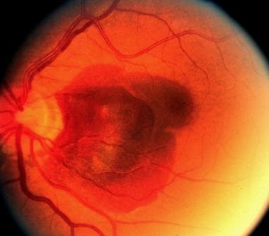 angioid streaks of the retina