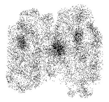 multinodular goiter histology