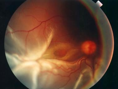 Clinical picture of a rhegmatogenous retinal detac
