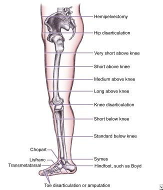 Above Knee Prosthesis - Above Knee Amputation - Amputees - What We Treat 