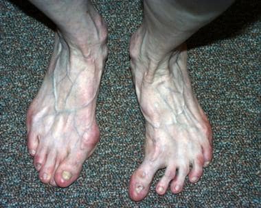 Clinical photo of idiopathic hallux varus of left 