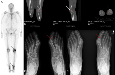 A three-phase bone scan of the lower extremities (