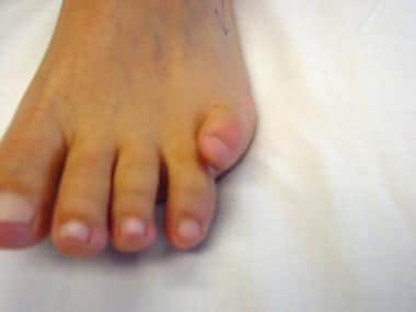 Fifth-toe deformities. Painful overlapping fifth-t
