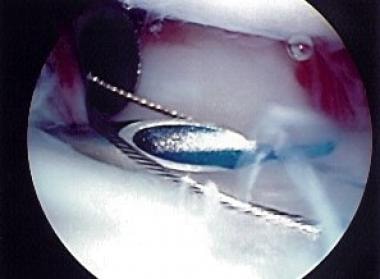 Palmer class 1B tear of triangular fibrocartilage 