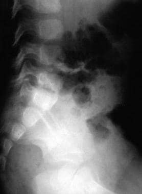 Lateral radiograph of the lumbosacral spine. This 