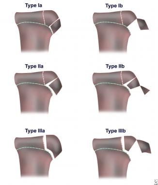 Classification of tibial tuberosity fractures. 