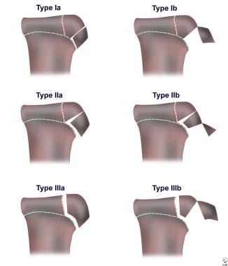 tibial tuberosity surface anatomy