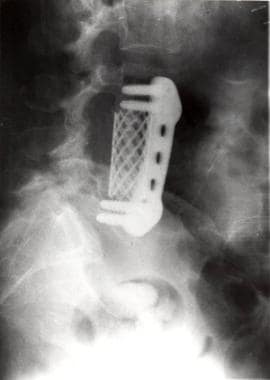 Spinal infections. Patient B developed lower-extre