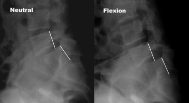 Lateral cervical spine showing C0-C3 fusion in reduced position after