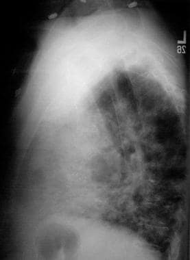 Lateral chest radiograph of a 50-year-old man with
