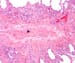 Pulmonary Veno-occlusive Disease