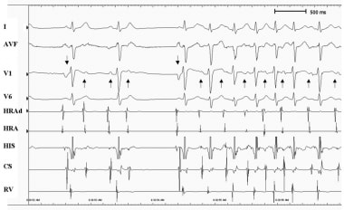 ectopic atrial tach