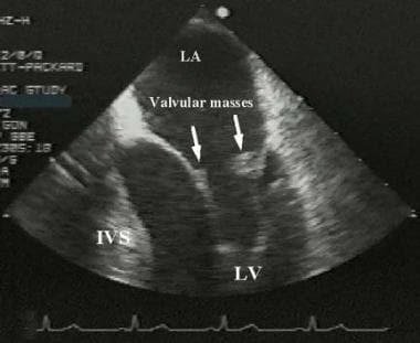 Libman-Sacks Endocarditis. Transesophageal image o