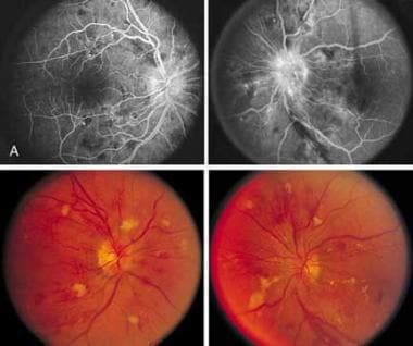 Hypertensive retinopathy. Note the flame-shaped he