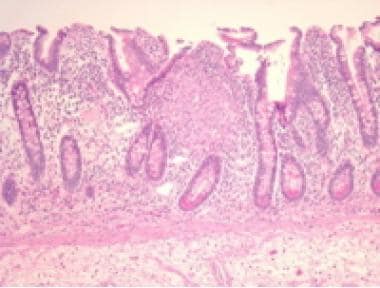Crohn disease. The histologic image shows granulom