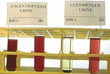 Rapid test to distinguish hematuria from hemoglobi