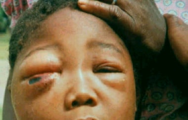 Anthrax with facial edema. Courtesy of American Ac