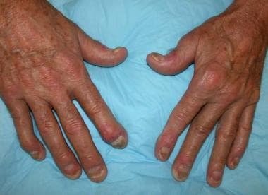 Psoriatic arthritis showing nail changes, distal i